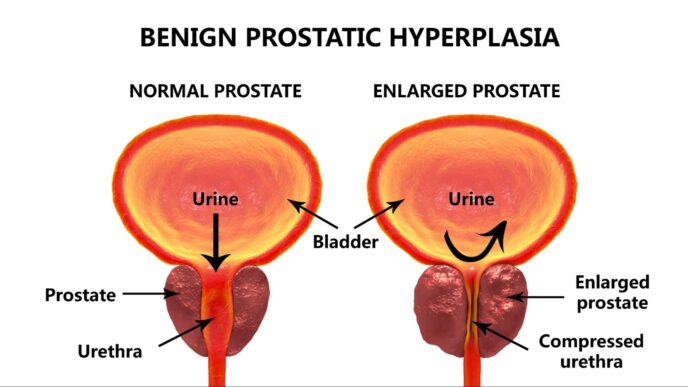 5 Signs of an Enlarged Prostate